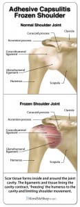 frozen-shoulder-adhesive-capsulitis-rotator-cuff